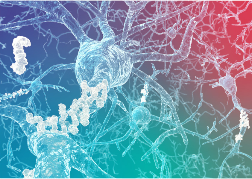 Illustration of transparent neurons with white plaques on branches against a blue to pink gradient background.